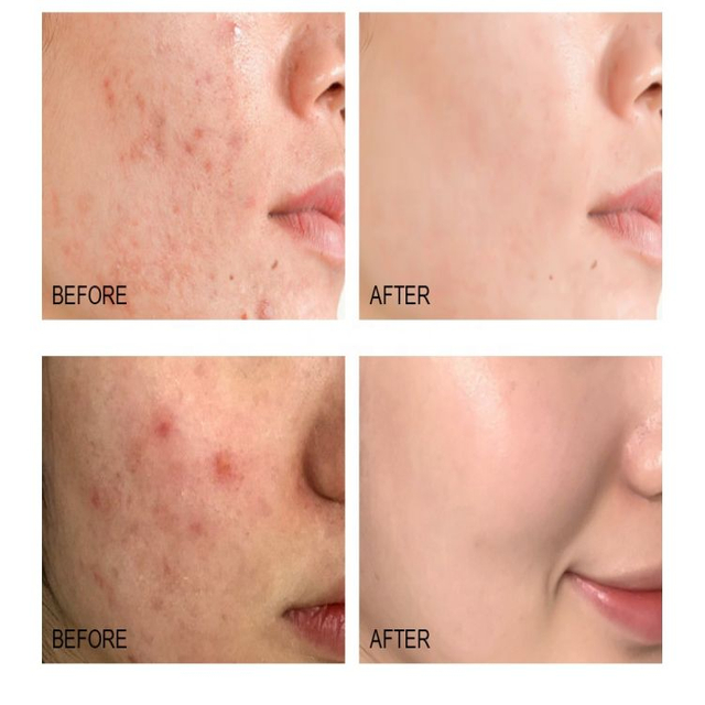 เซรั่มรักษาสิว